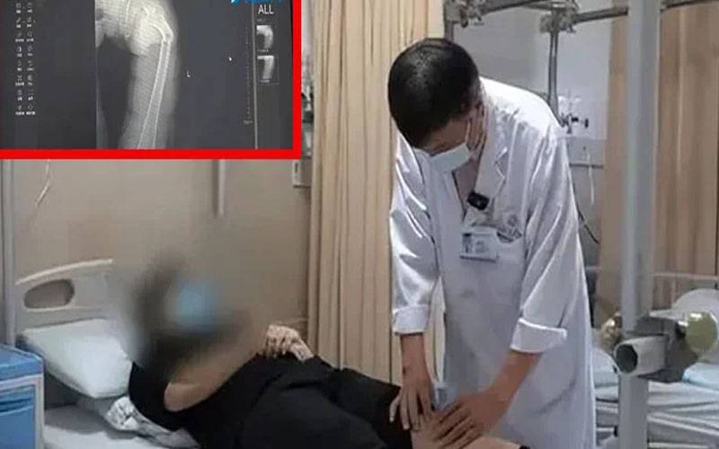 کھانسی سے 35 سالہ شخص کی ران کی ہڈی ٹوٹ گئی ، ڈاکٹرز بھی حیران